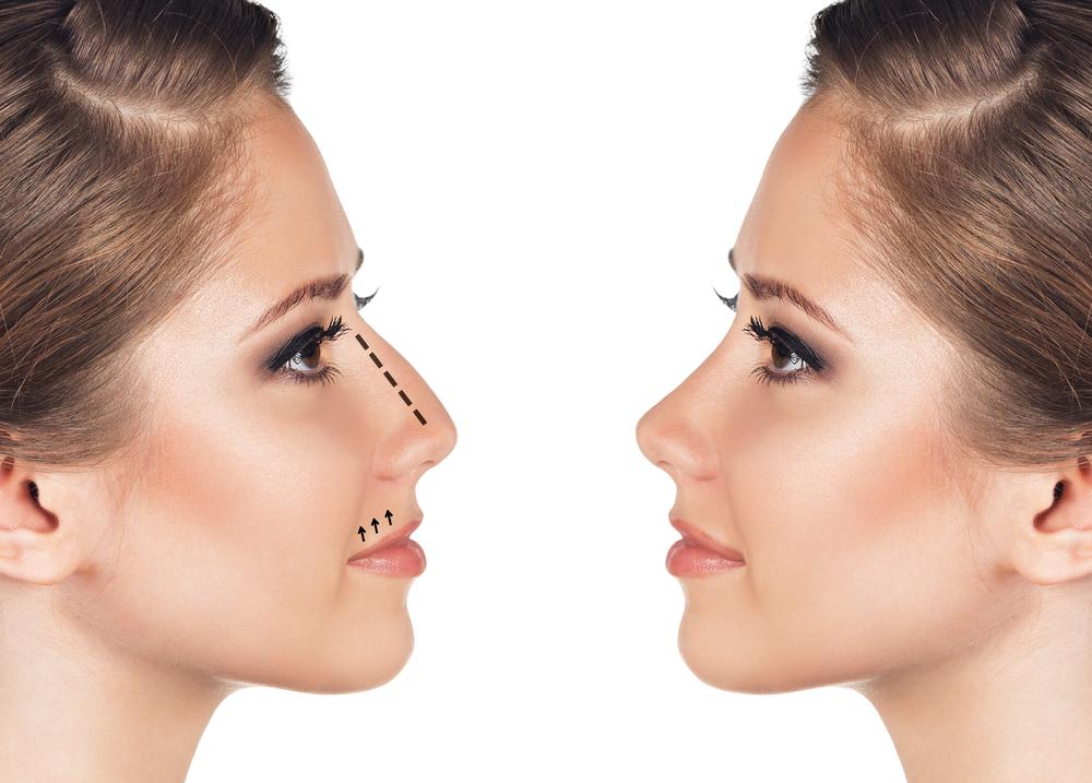 شرایط جراحی بینی