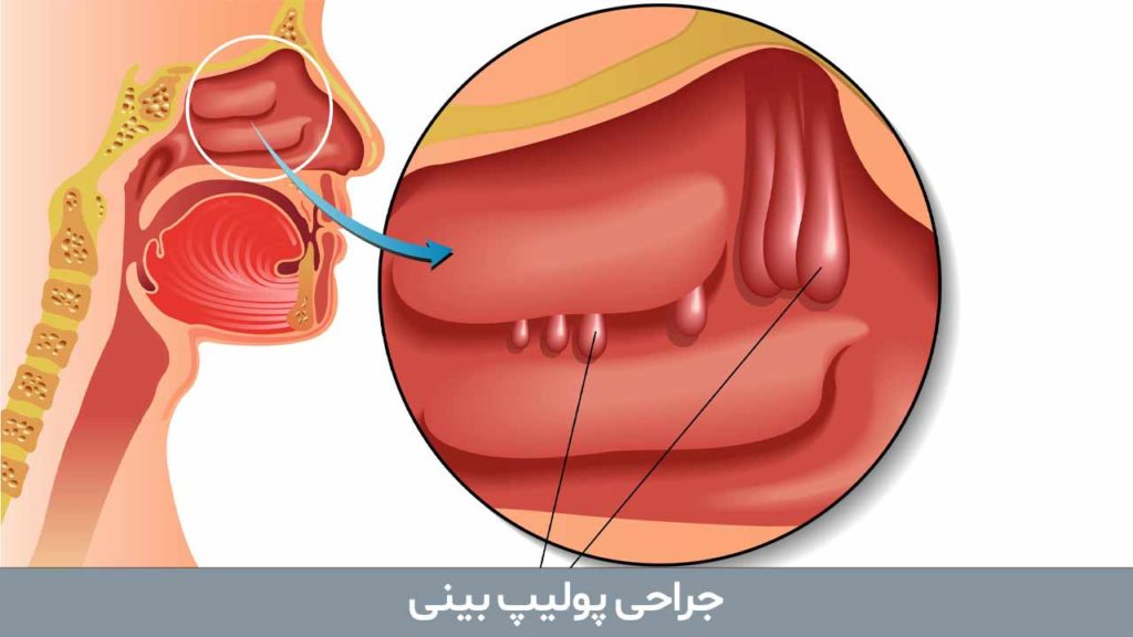 جراحی پولیپ بینی