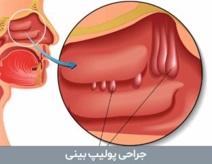 جراحی پولیپ بینی