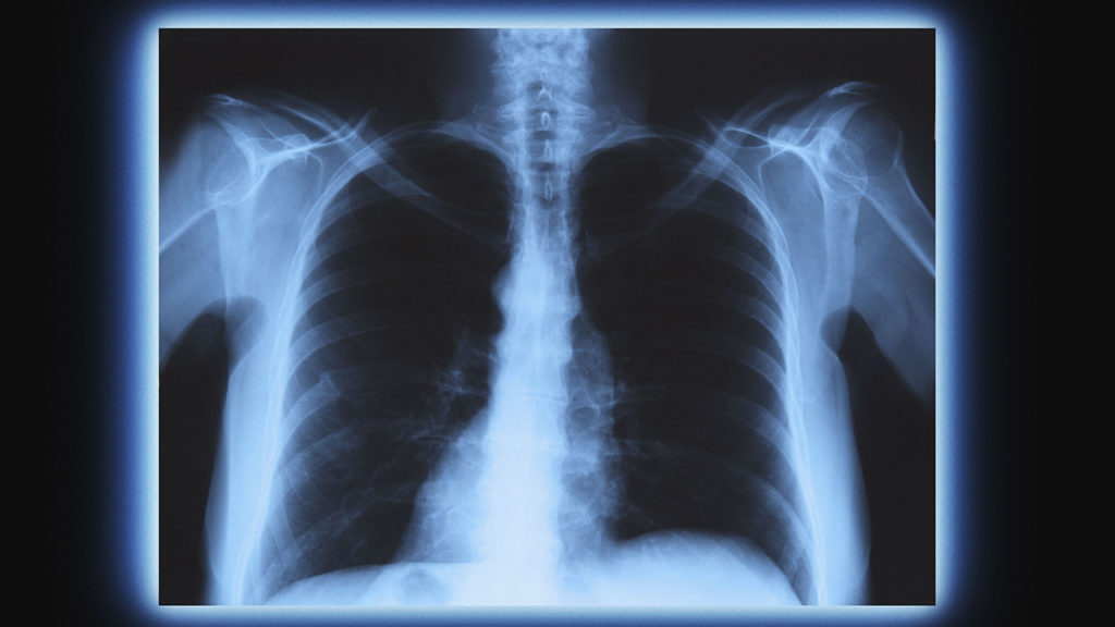 عکس رادیولوژی از قفسه سینه