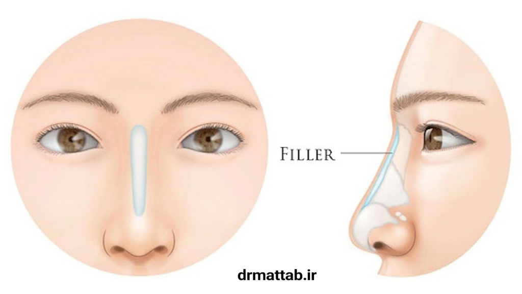 فیلر بینی چیست؟