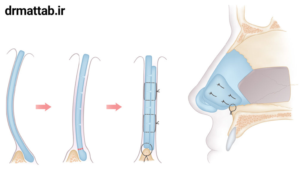 پیوند غضروف در جراحی بینی
