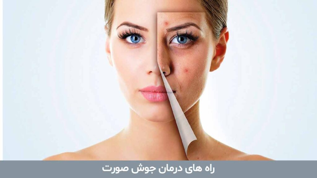 راه های درمان جوش صورت