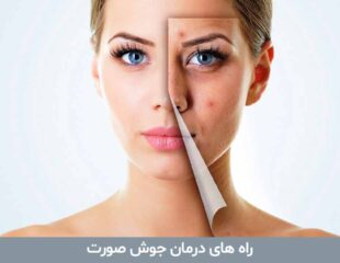 راه های درمان جوش صورت