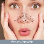 درمان جوش سر سیاه