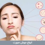 انواع جوش صورت