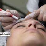 کاشت ابرو به روش fit