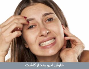 خارش ابرو بعد از کاشت