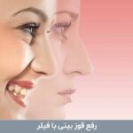 رفع قوز بینی با فیلر