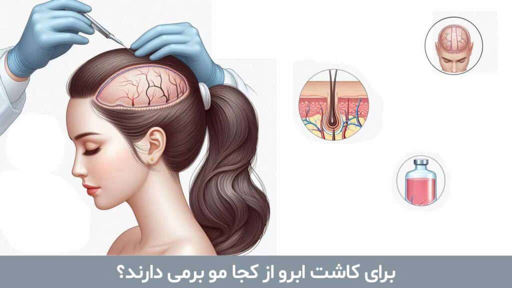 برای کاشت ابرو از کجا مو برمی دارند؟