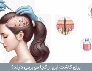 برای کاشت ابرو از کجا مو برمی دارند؟