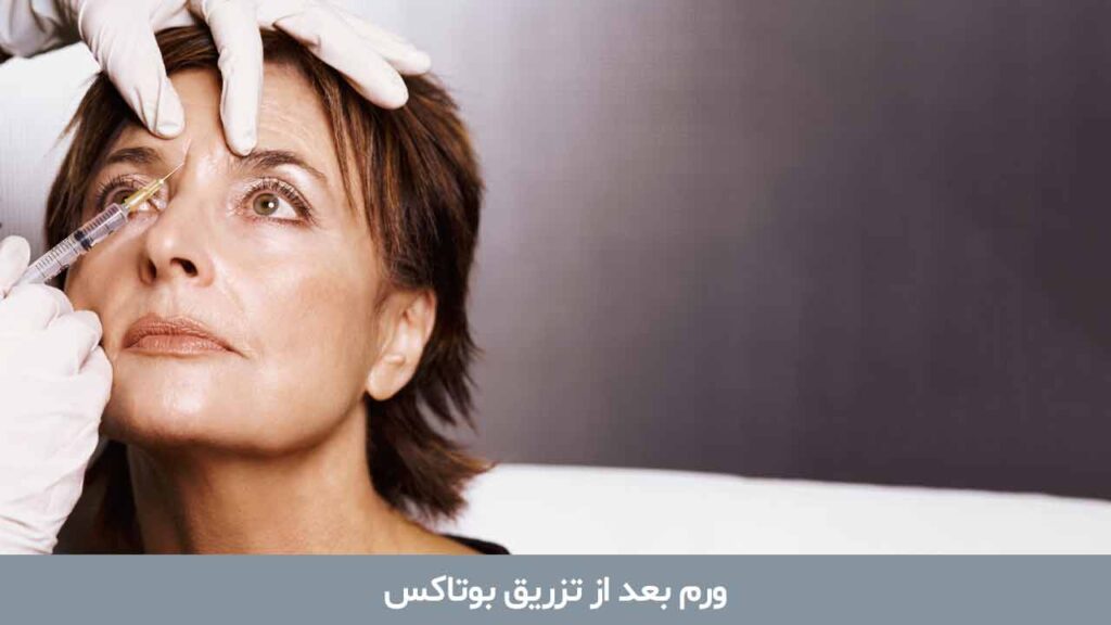 ورم بعد از تزریق بوتاکس